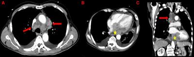 Case report: Diagnosis, management and evolution of a bulky and invasive cardiac mass complicated by complete atrioventricular block